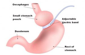 Virtual gastric band: a safe alternative to surgical procedures